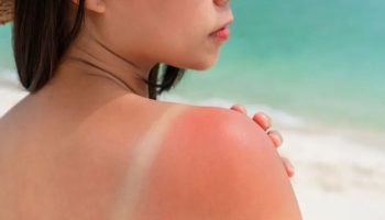 Ni led ni aloe vera: 2 sastojka koji smiruju peckanje od opekotina od sunca tokom leta