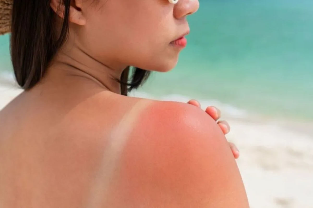 Ni led ni aloe vera: 2 sastojka koji smiruju peckanje od opekotina od sunca tokom leta