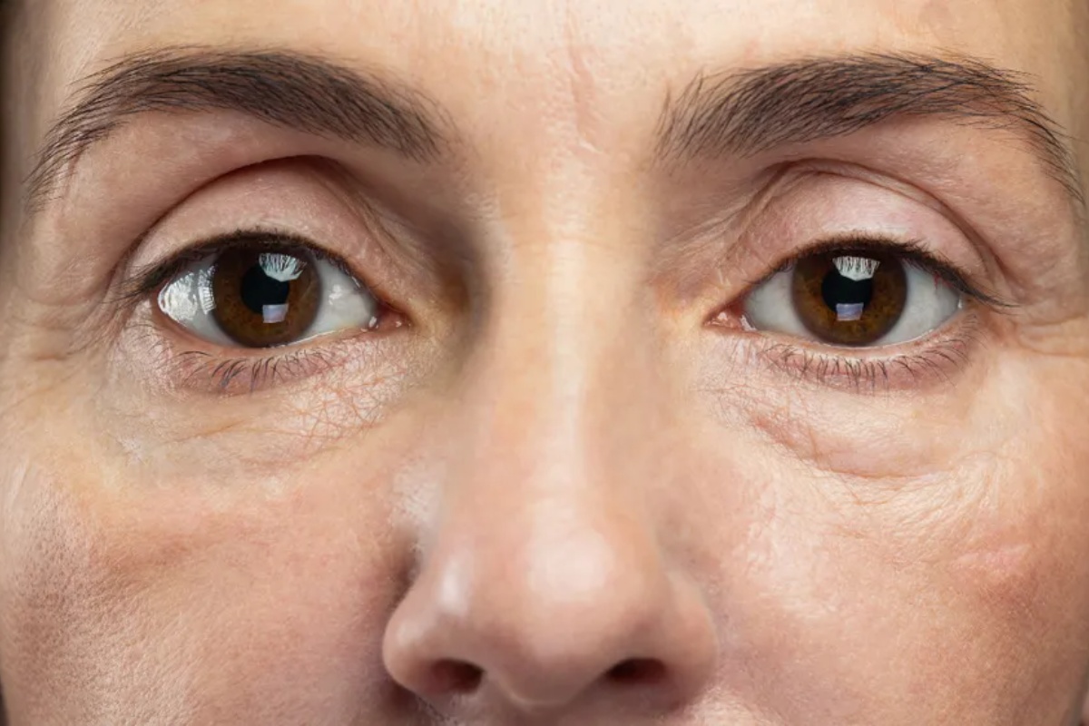 Kese ispod očiju: uobičajena greška pri lečenju i voće koje pomaže u obnavljanju kolagena