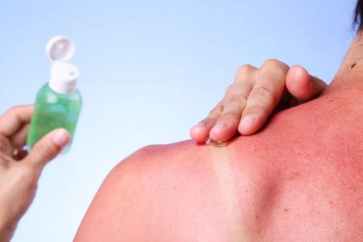 Ni led ni aloe vera: 2 sastojka koji smiruju peckanje od opekotina od sunca tokom leta – image 3