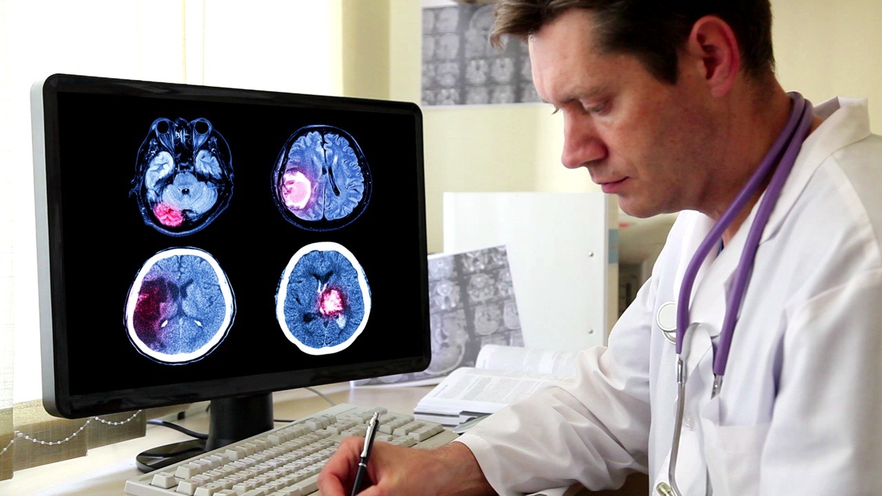 Agresivni tumori mozga i izazovi liječenja