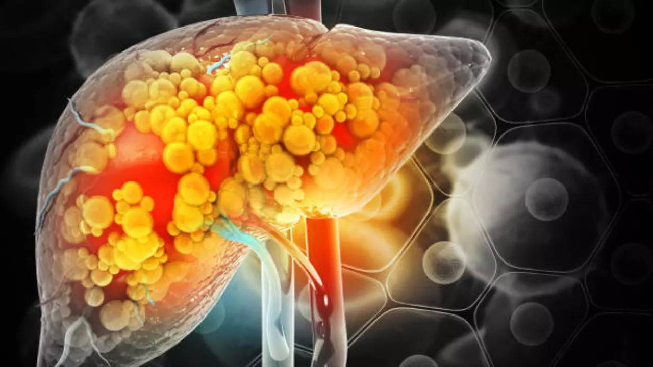 Bolest masne jetre: koja je preporučena dnevna konzumacija kave za smanjenje upale?