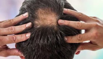 Jednostavan i brz odgovor na ćelavost: ovo je prirodni lijek koji pomaže u sprječavanju opadanja kose.