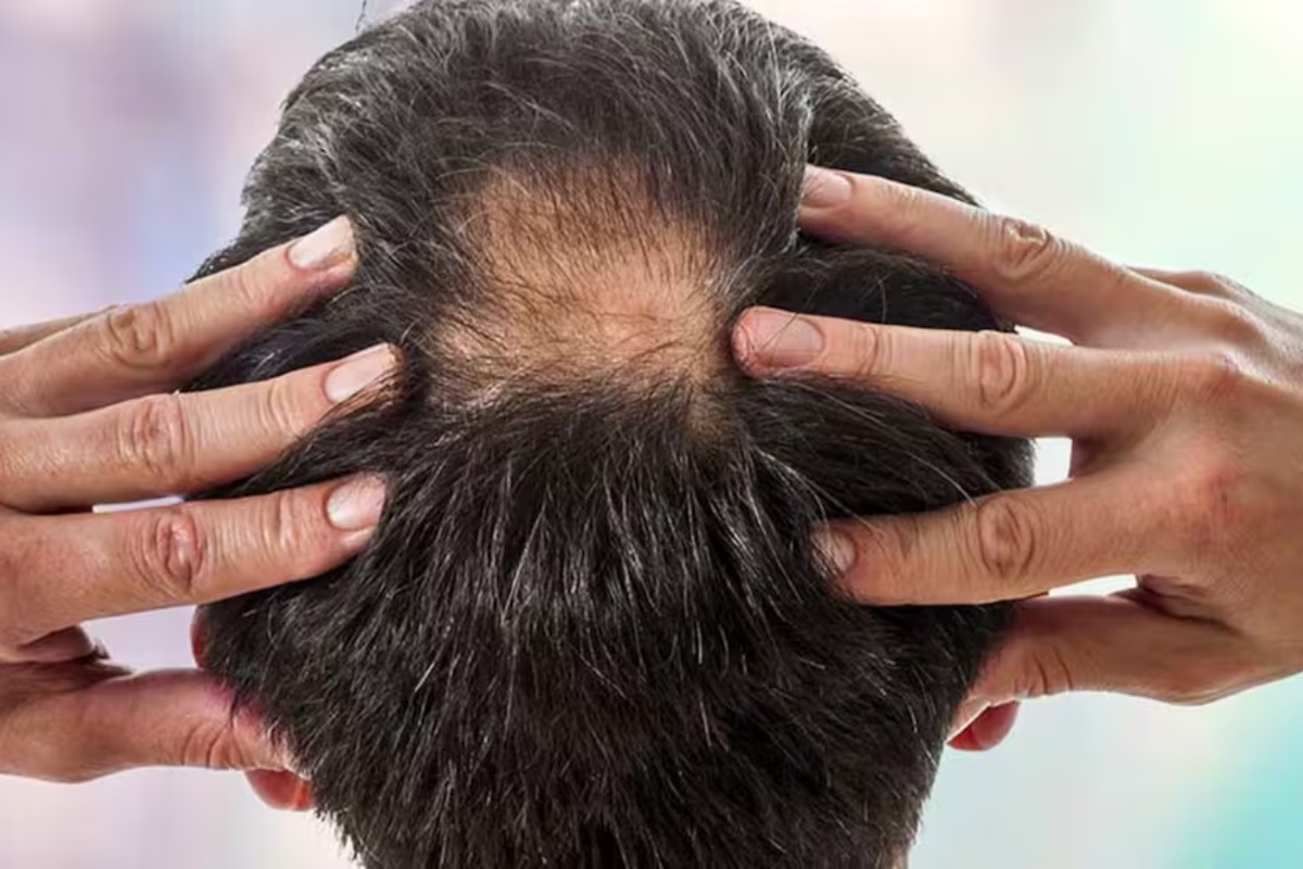 Jednostavan i brz odgovor na ćelavost: ovo je prirodni lijek koji pomaže u sprječavanju opadanja kose.