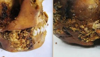 Otkriće koje je iznenadilo medicinu: Kompleksna operacija stara 2500 godina