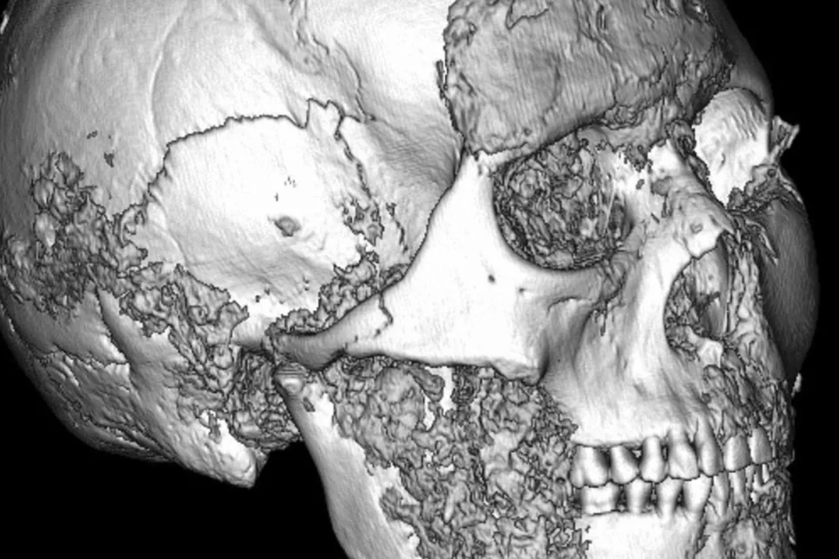 Otkriće koje je iznenadilo medicinu: Kompleksna operacija stara 2500 godina – image 1