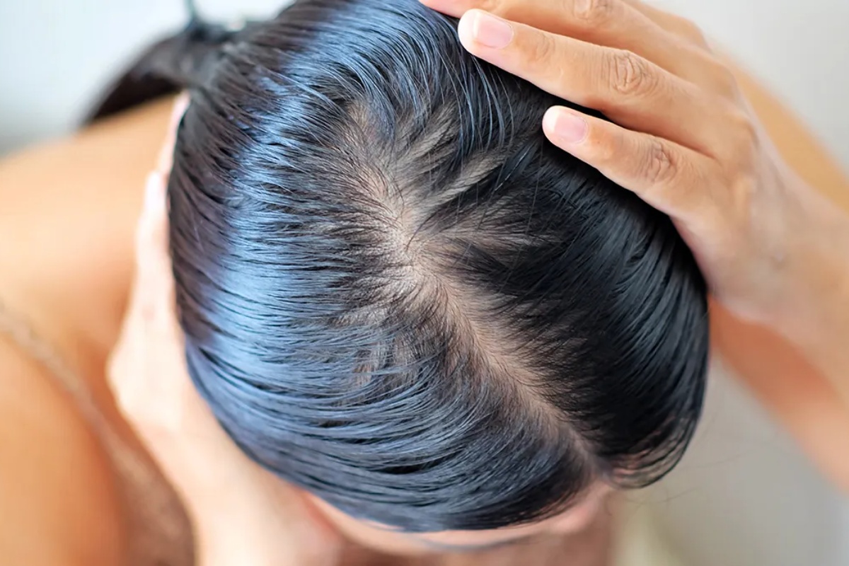 Kako sprečiti žensku alopeciju pomoću ruzmarina: efikasan domaći lek – image 2