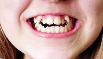 ”Vinojen hampaiden epidemia”: suurin osa lapsista ja nuorista tarvitsee oikomishoitoa.