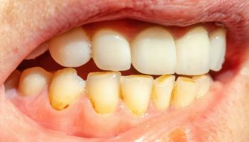 Ni ocat ni soda bikarbona: Nevjerojatan kućni trik za uklanjanje zubnog kamenca