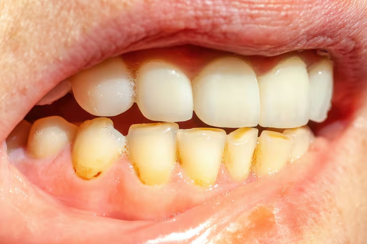 Ni ocat ni soda bikarbona: Nevjerojatan kućni trik za uklanjanje zubnog kamenca